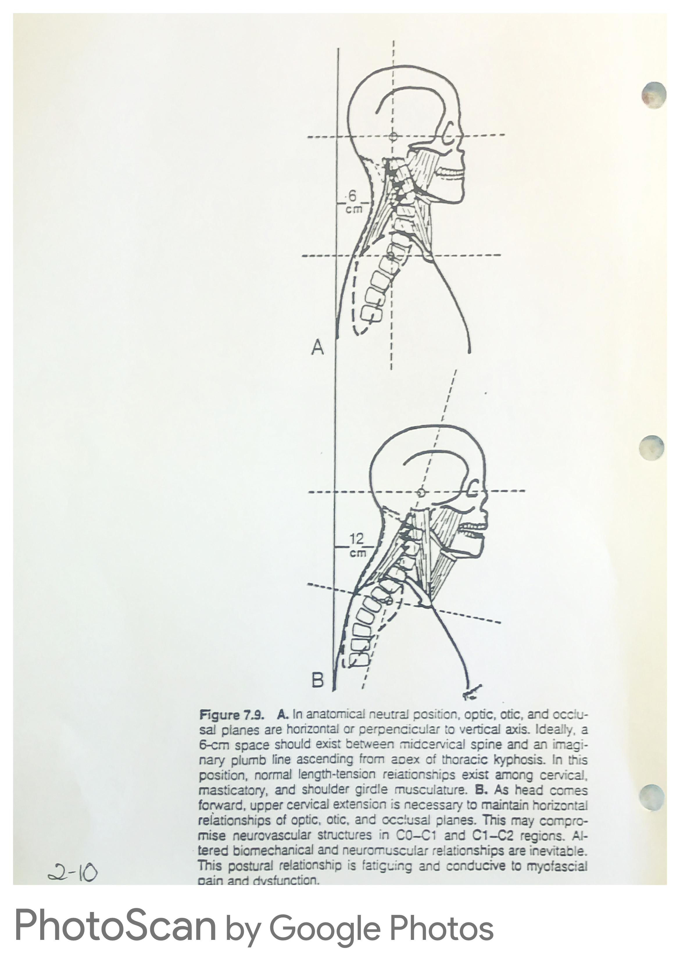 Forward head posture measurement — 6cm neutral vs 12cm forward head