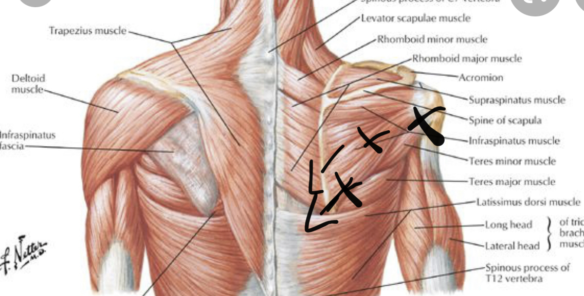 Upper back musculature — Trapezius, Rhomboids, Levator Scapulae, Infraspinatus, Teres, Latissimus Dorsi
