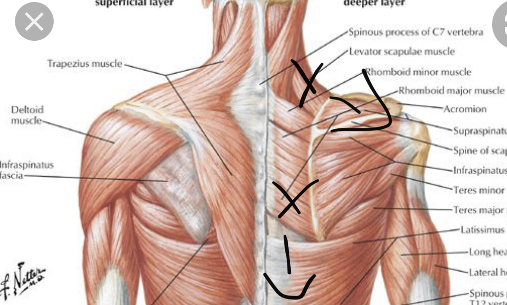 Upper back musculature — superficial and deeper layers with release annotations