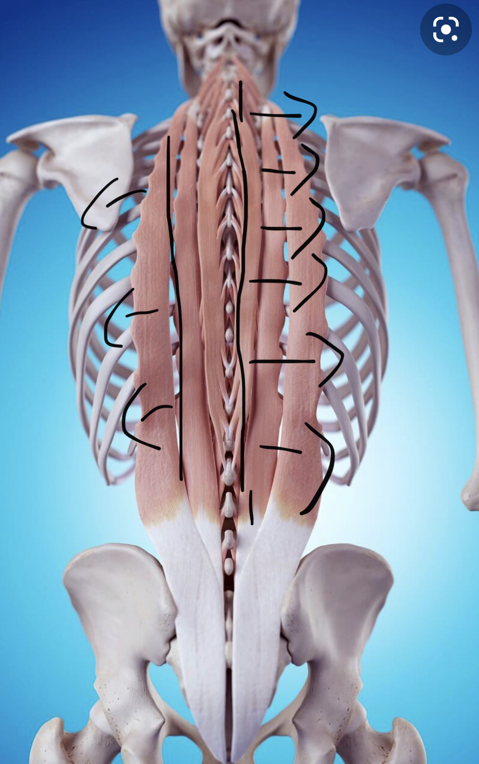 Erector spinae muscles — annotated with lateral release directions