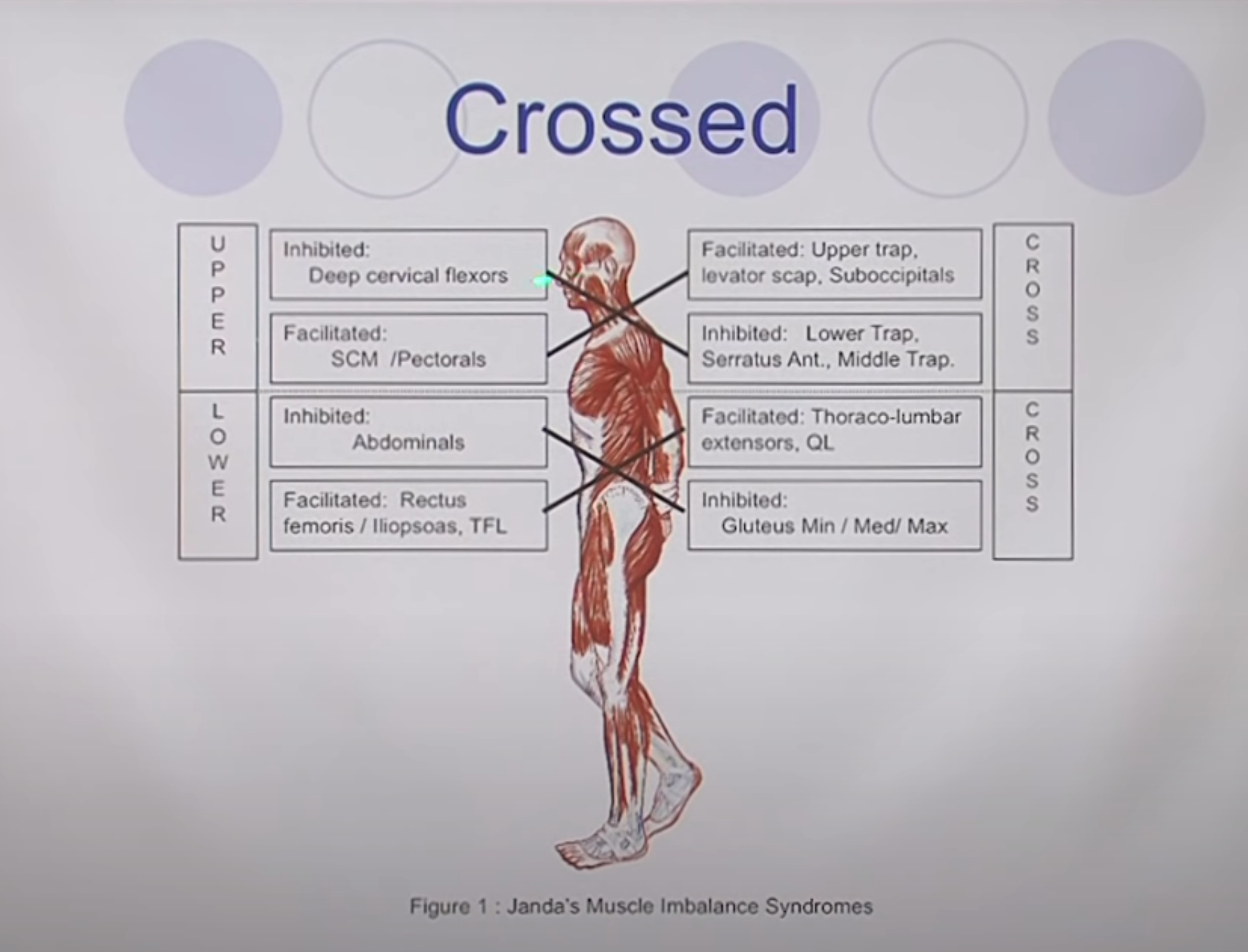 Janda's Crossed Syndrome — upper cross and lower cross muscle imbalances