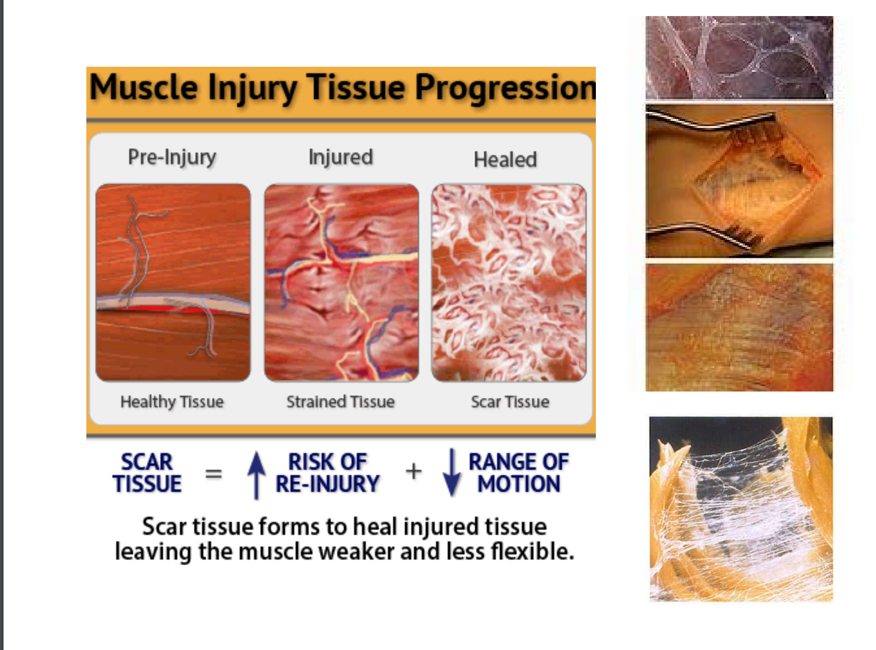 Muscle injury tissue progression — healthy tissue, strained tissue, scar tissue