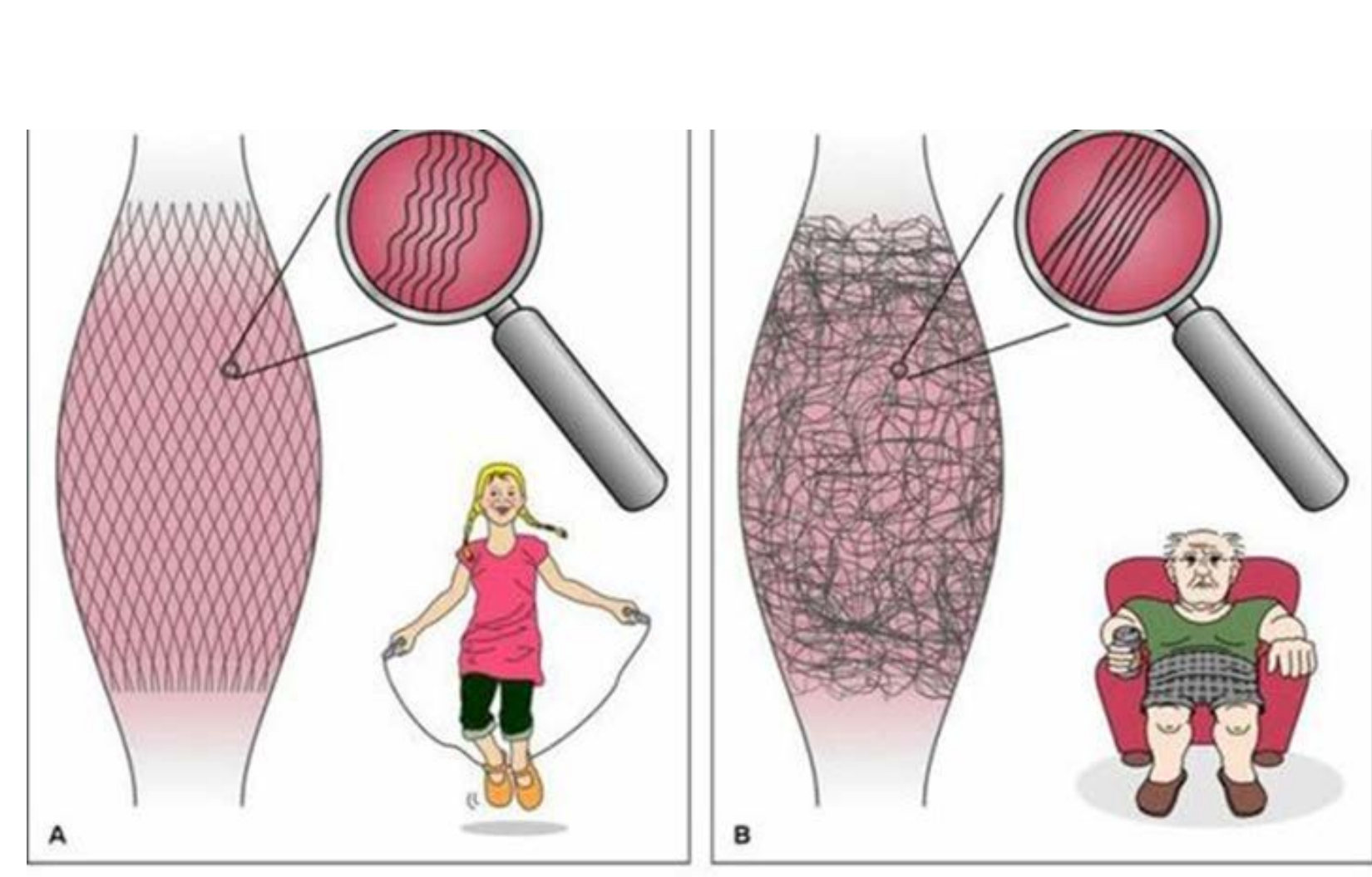 Healthy vs restricted fascia fiber comparison