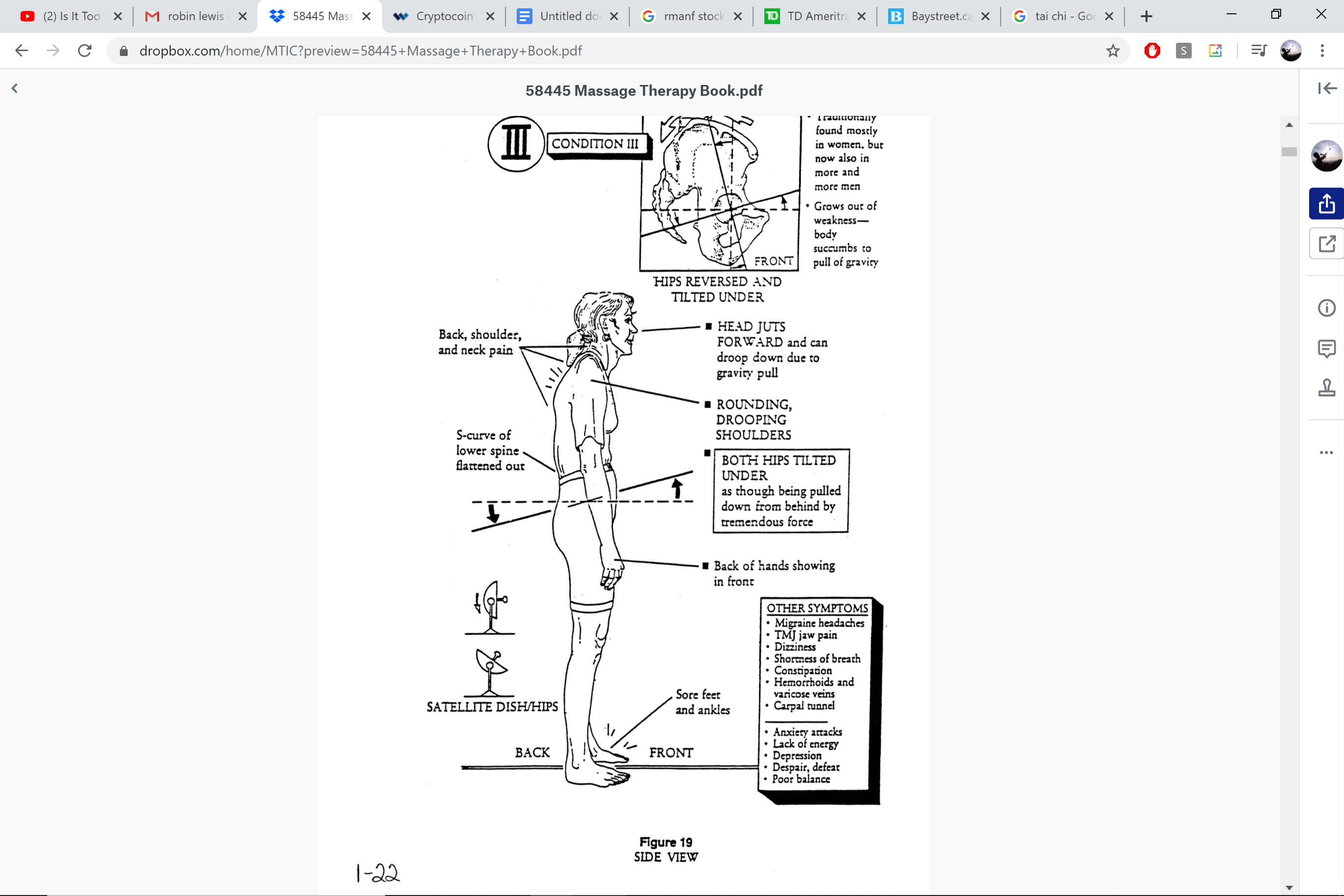 Condition III — hips reversed and tilted under
