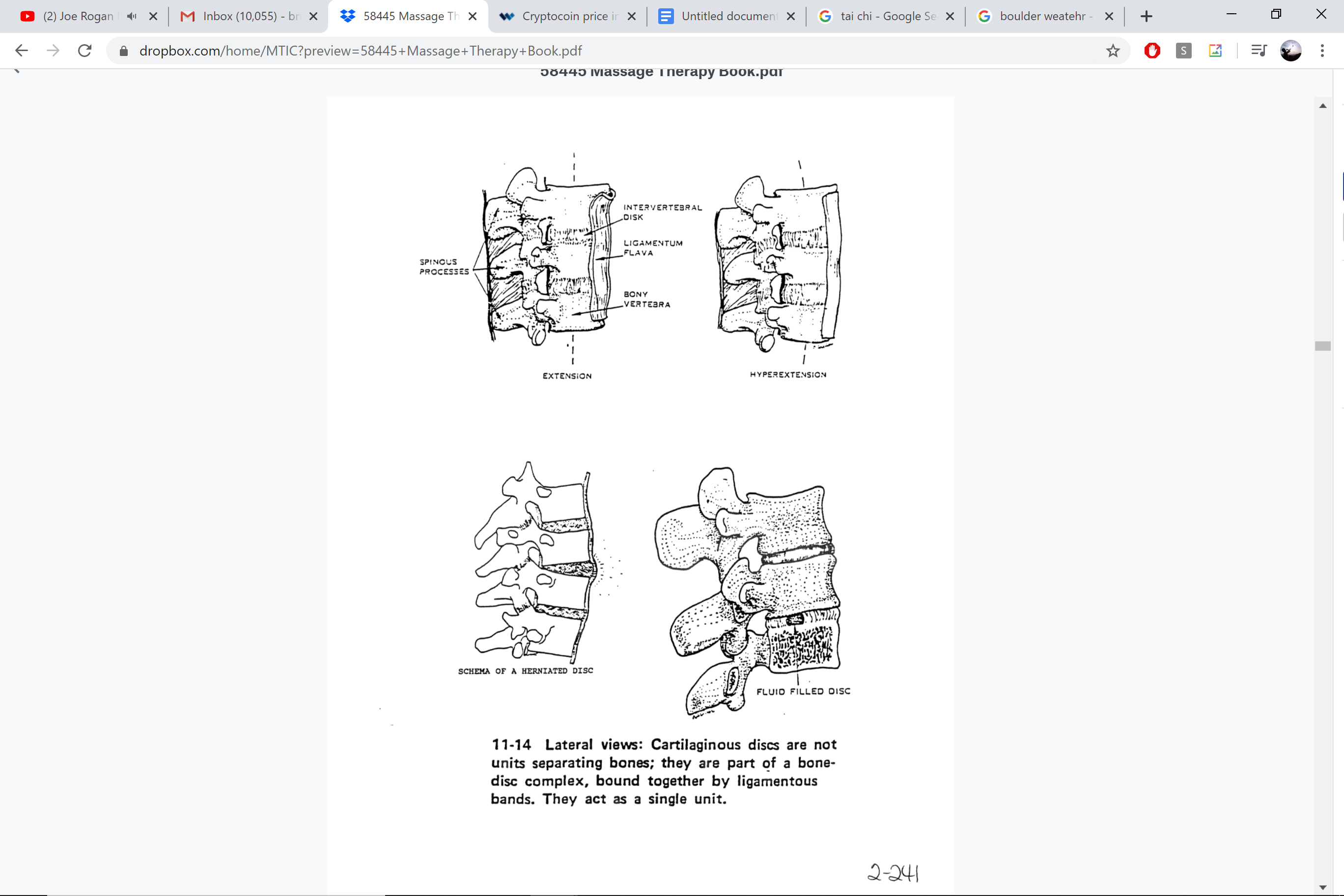 Spinal disc — extension vs. hyperextension, herniated disc schema
