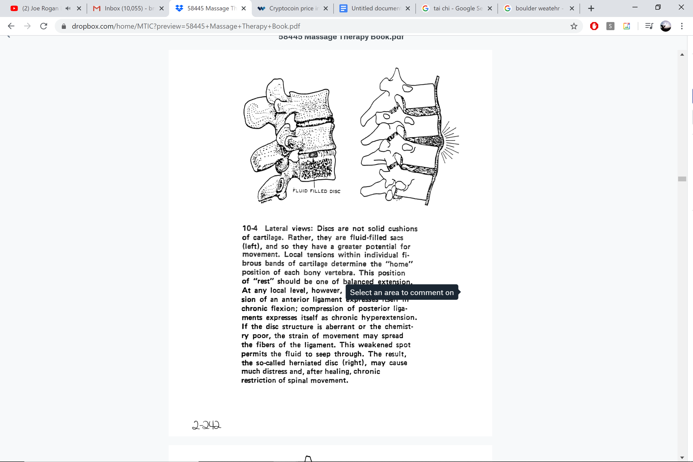 Fluid disc vs. herniated disc — stages of disc degeneration
